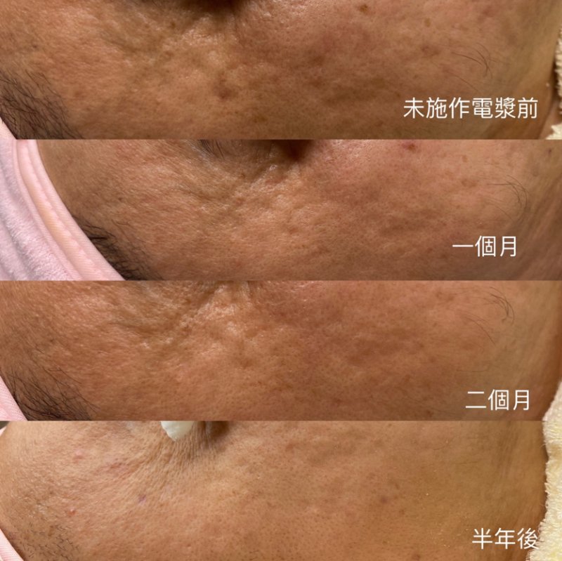 中山大學醫學院副院長、生物醫學科技學系特聘教授林哲信團隊，歷經20年研發出「大面積餘暉放電冷電漿」系統，不僅能讓嚴重糖尿病足「枯木逢春」，更顛覆傳統依賴抗生素的傷口治療模式，還可應用於醫學美容淡斑、美白等。目前該技術已100%由台灣團隊掌握，並成功技轉給在地企業「瀧儀生醫科技股份有限公司」，相關產品即將問世，預期將為全球龐大的傷口照護市場帶來革命性的改變。