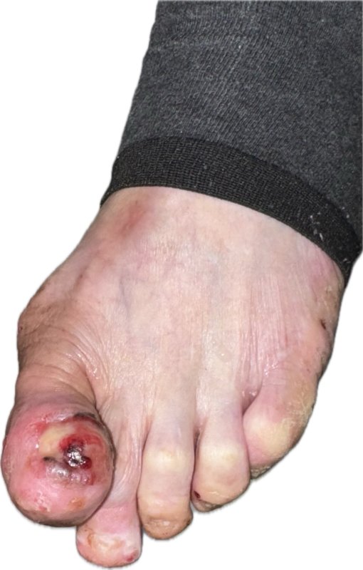 漾新聞｜誤當甲溝炎險喪命 高醫揪出皮膚癌之冠救回一命